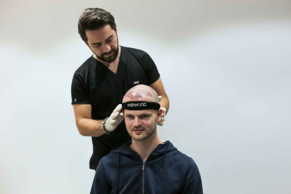 Post Hair Transplant Check Up Dr. Burak Tuncer