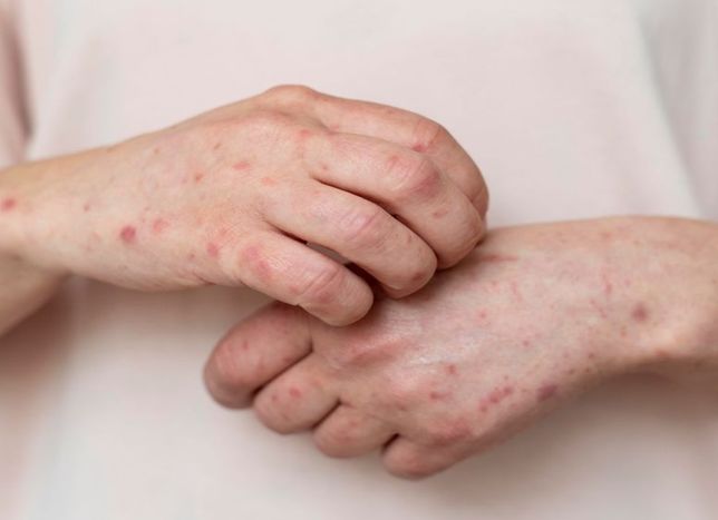 Residents urged to check their vaccination status following measles outbreak