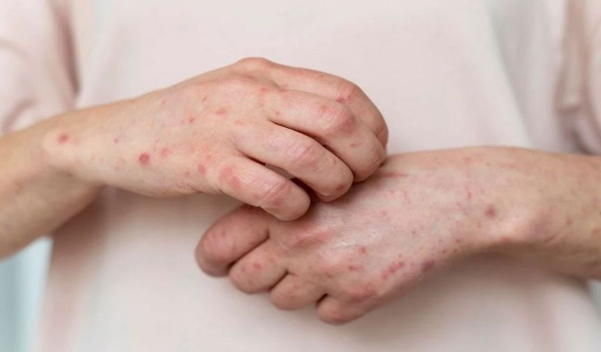 Measles Outbreak Confirmed in Enfield